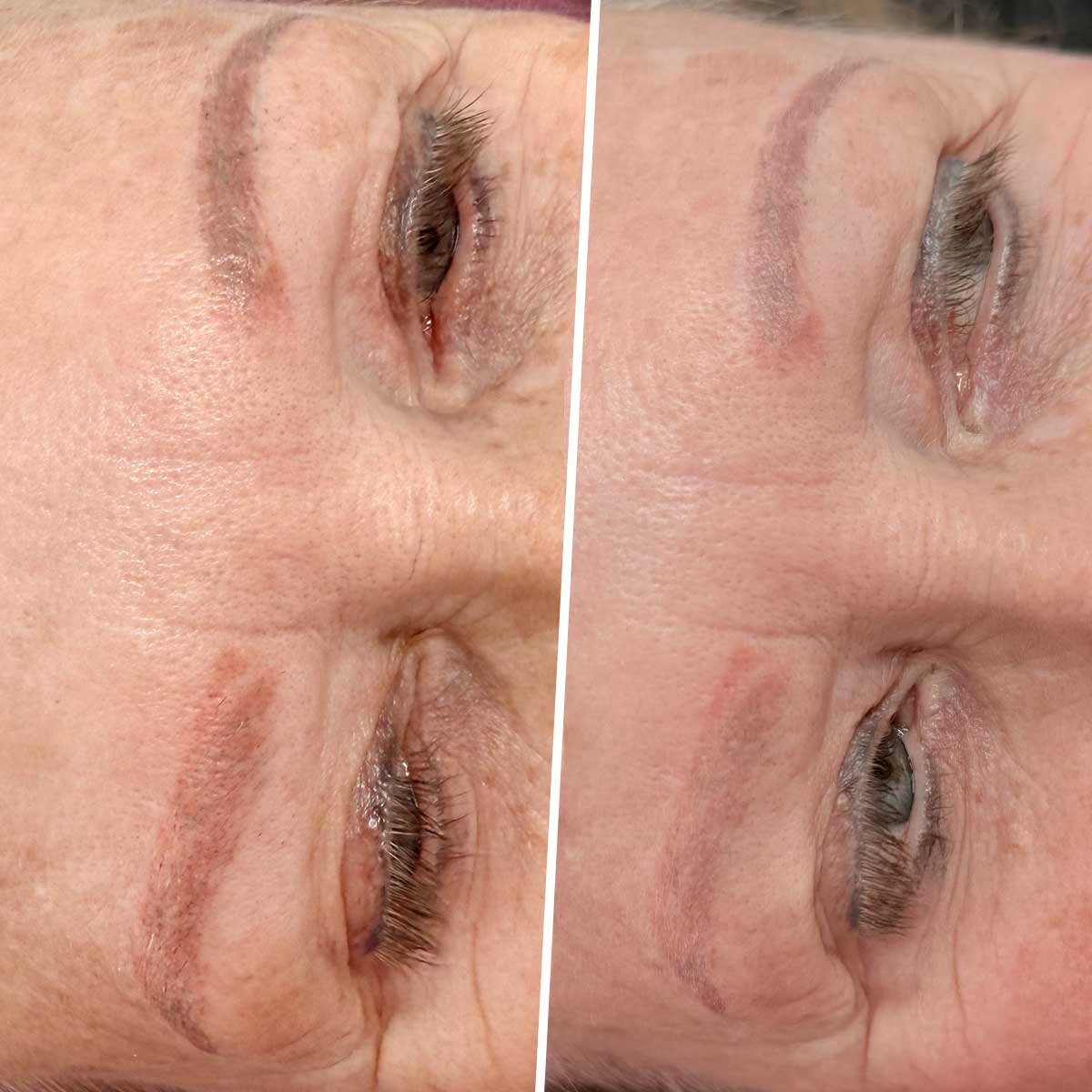 Permanent Makeup Removal in Naples, FL