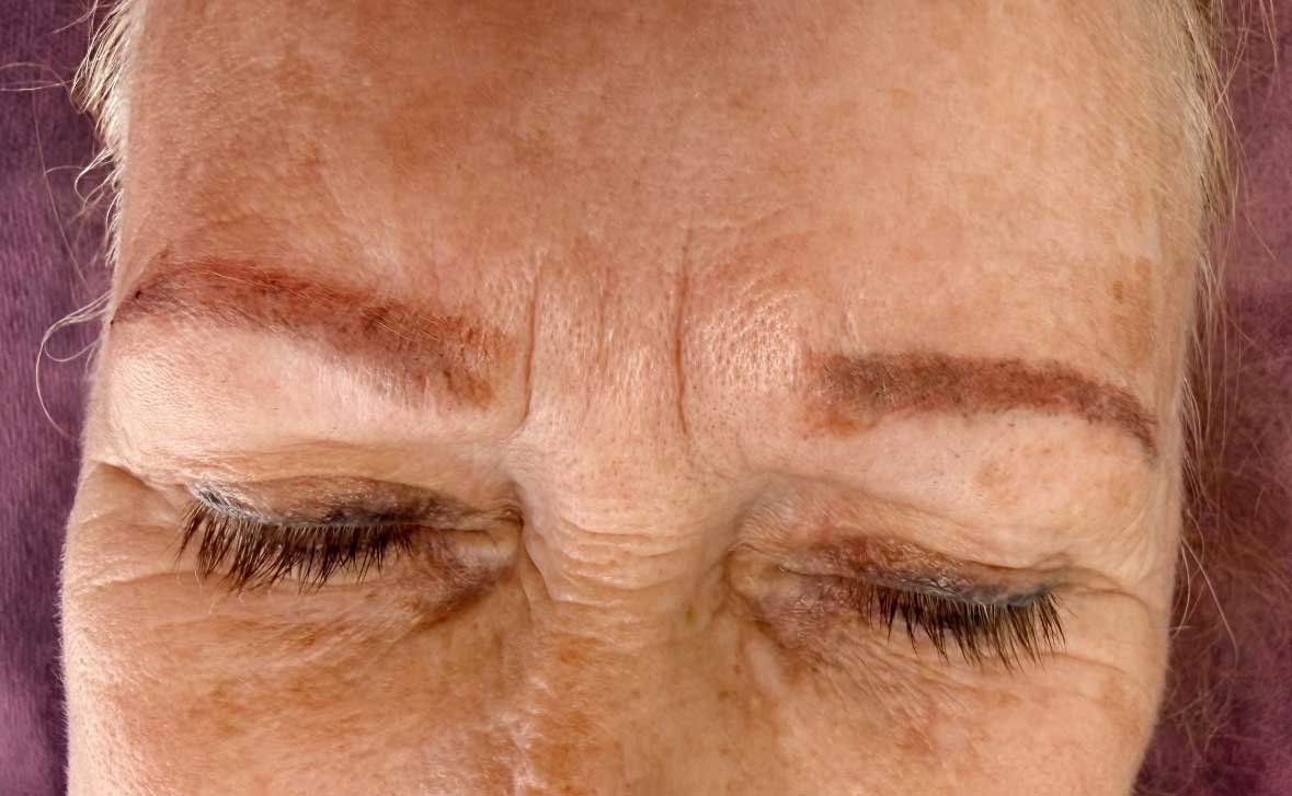 Before Treatment