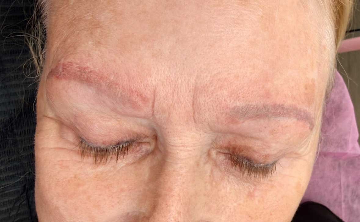 After Two Saline Removal Sessions