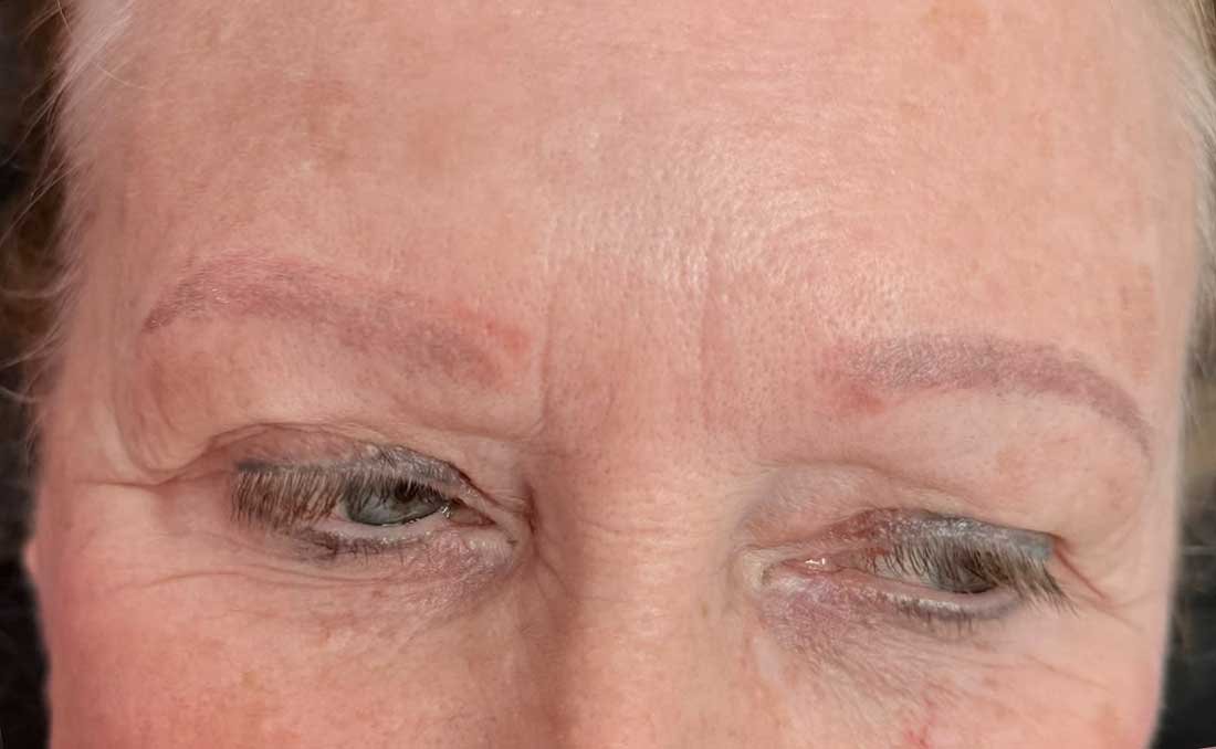 After Three Saline Removal Sessions